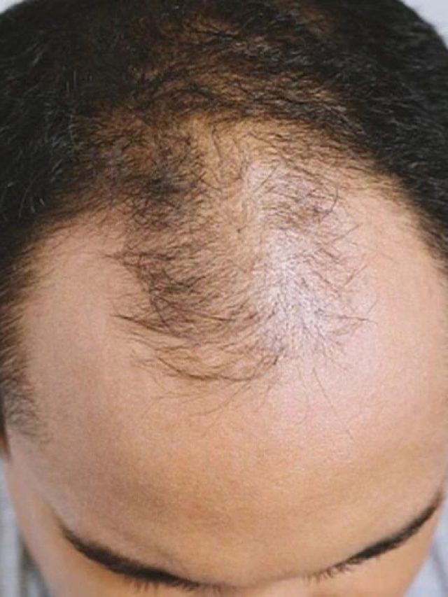 পুরনো টাকেও গজাবে দুব্বোর মতো চুল, তবে এই জিনিস লাগাতেই হবে