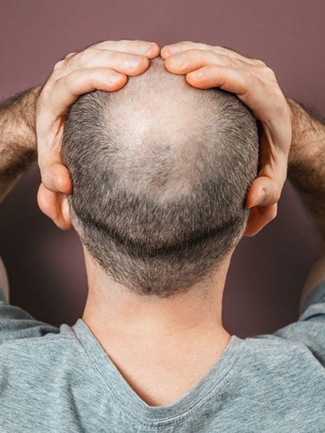 মাথার মাঝখানে চুল উঠে টাক? ন্যাড়া হওয়ার আগে এই সবজি ঘষে ফেলুন