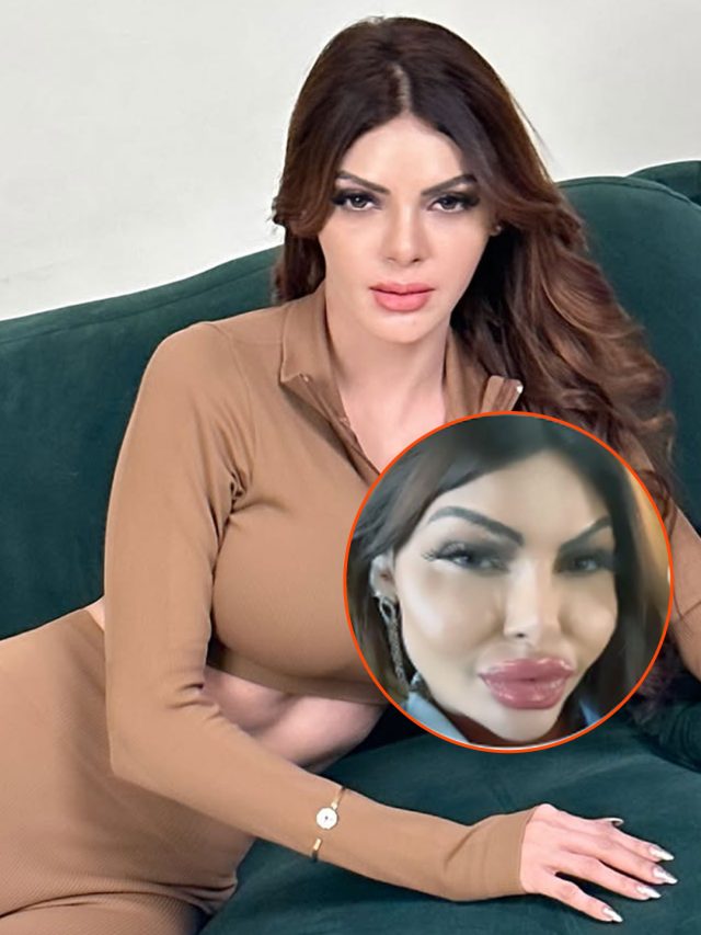 सूजे हुए गाल-मोटे होंठ, फिलर्स ने बिगाड़ा एक्ट्रेस का चेहरा, बोली- किस मनहूस...