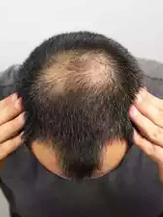 नारियल तेल से गंजे सिर पर ऐसे करें मालिश, फिर से हो सकती है बालों की ग्रोथ!