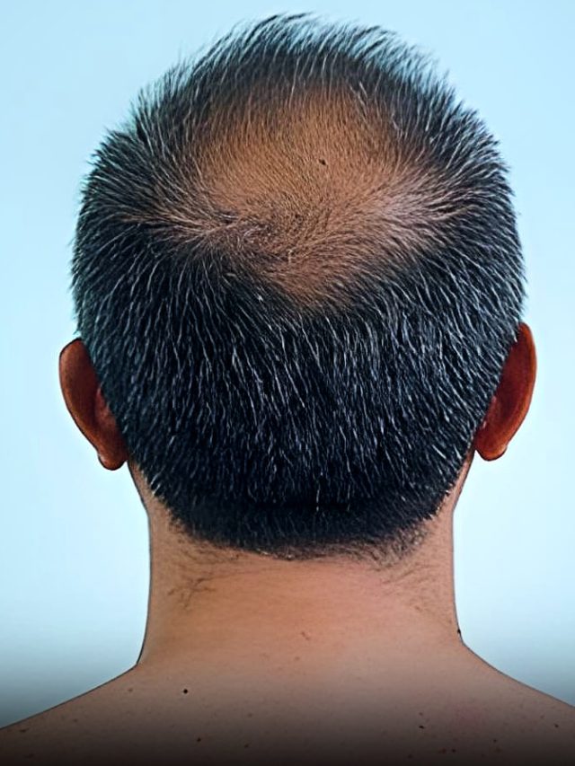 सिर के पीछे के बाल क्यों नहीं झड़ते? हेयर ट्रांसप्लांट डॉक्टर ने बताया