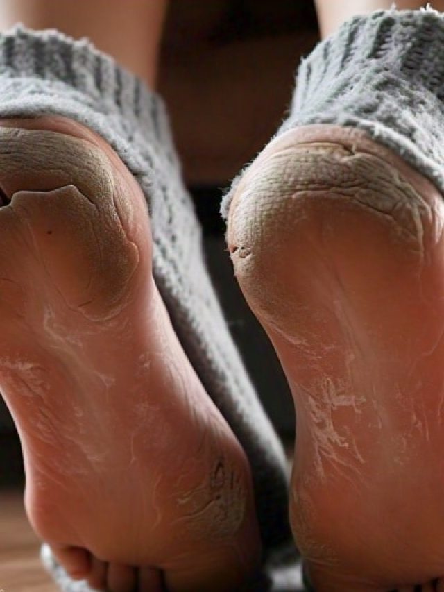 सर्दियों में फट रही हैं आपकी एड़ियां? इन उपायों से हो जाएंगी रूई सी मुलायम