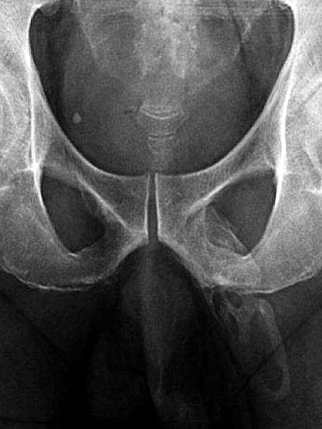 हड्डी बन गया पुरुष का प्राइवेट पार्ट! दुर्लभ बीमारी से वैज्ञानिक भी हैरान