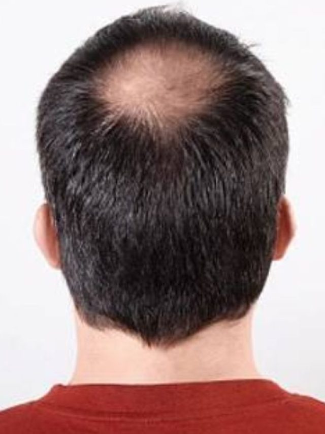 मेरठ: गंजेपन के इलाज का कर रहे थे दावा... सामने आई ये सच्चाई