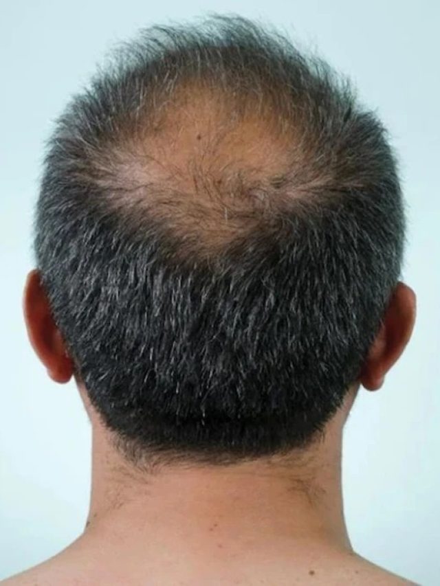 পুরনো টাকেও গজাবে গোছা গোছা চুল,  শুধু এই জিনিস লাগাতে থাকুন