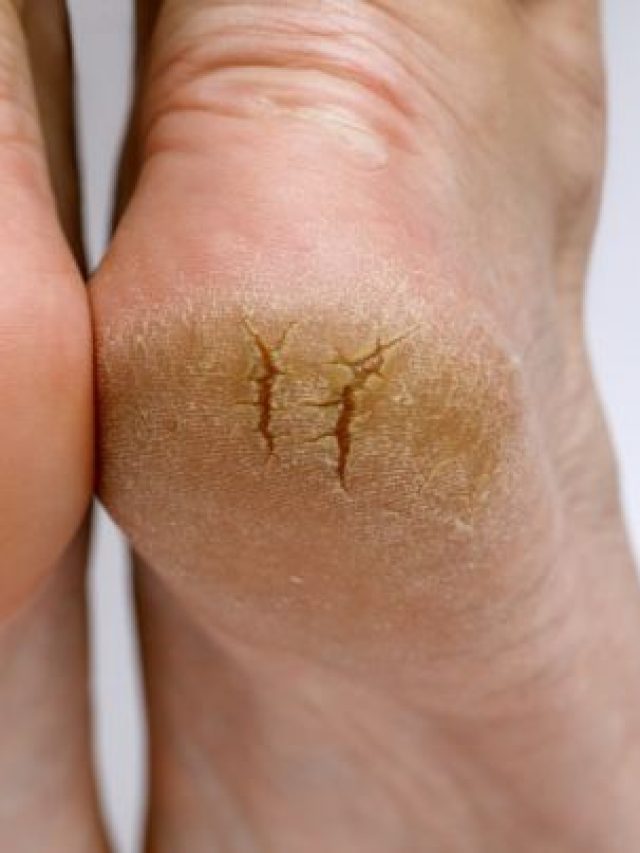 শীতেও ফাটা গোড়ালি থাকবে নরম তুলতুলে, পার্লার দিদির সিক্রেট টিপস