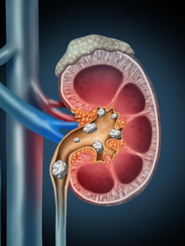 কিডনি স্টোন গলিয়ে দেবে সস্তার এই পাতা, এভাবে খেলে কাজ দেবে