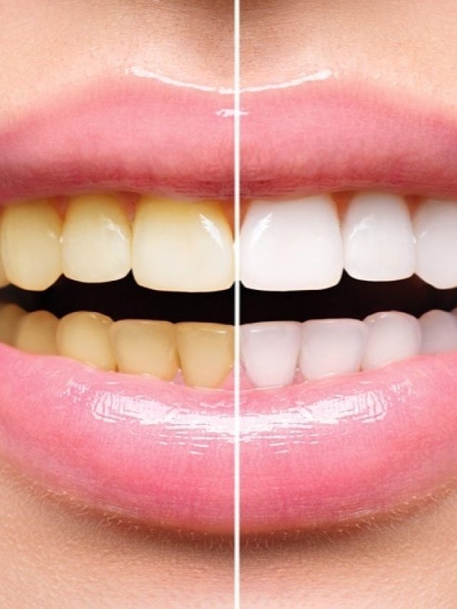 হেঁশেলের দুই জিনিস ঘষে নিন, দিদিমার টোটকায় হলদে দাঁত হবে সাদা