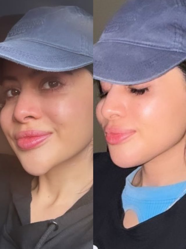 एक्ट्रेस ठोड़ी पर लेती रही दर्दनाक फिलर्स, 8-9 साल बाद बदला चेहरा, बोली- बहुत अजीब...