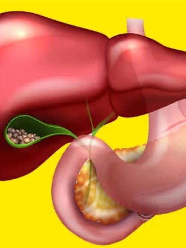 পেটে পাথর তৈরি করে এই ৫ খাবার,গলব্লাডার স্টোনের কারণ