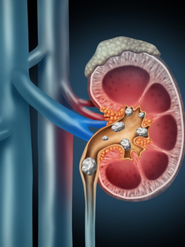 সস্তার এই পাতা গলিয়ে দেয় কিডনির পাথর, খাওয়ার পদ্ধতি জানেন?