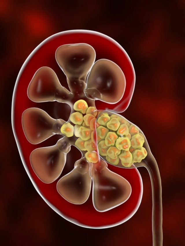 অপারেশন লাগবে না, এই পাতাই গলিয়ে দেবে কিডনি স্টোন
