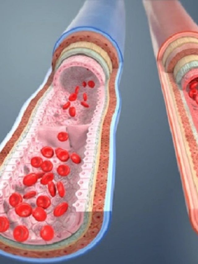 ইউরিক অ্যাসিড  গোপনে বাড়ছে? এই ৫ লক্ষণ দেখলেই সাবধান