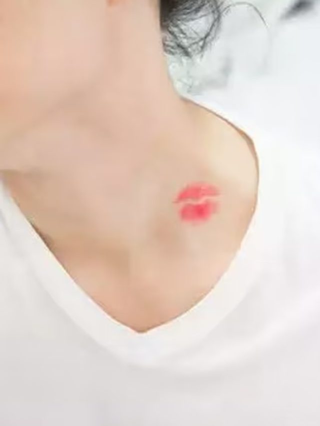 আদরের দাগ লোকাতে হিমসিম? রইল ঘরোয়া টোটকা