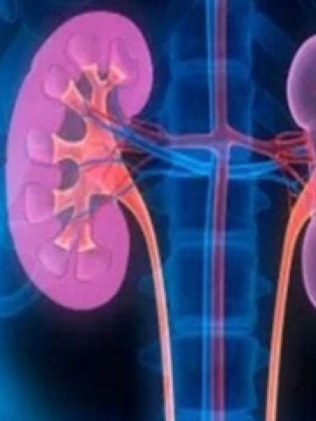 কিডনির পাথর  গলিয়ে দেয় এই ৫ খাবার, স্টোন হবেই না