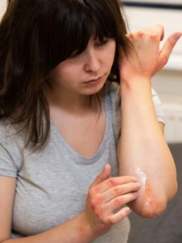 পোড়া জায়গায় টুথপেস্ট লাগানোর দরকার আছে? জেনে নিন