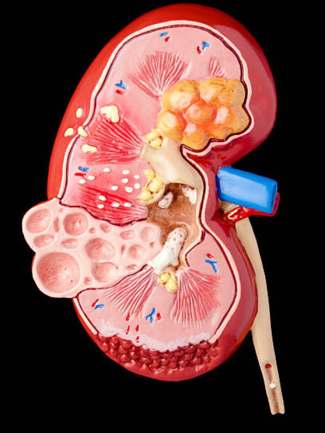 এই ৮ খাবারের কারণেই কিডনিতে পাথর হয়, জেনে সাবধান হোন!