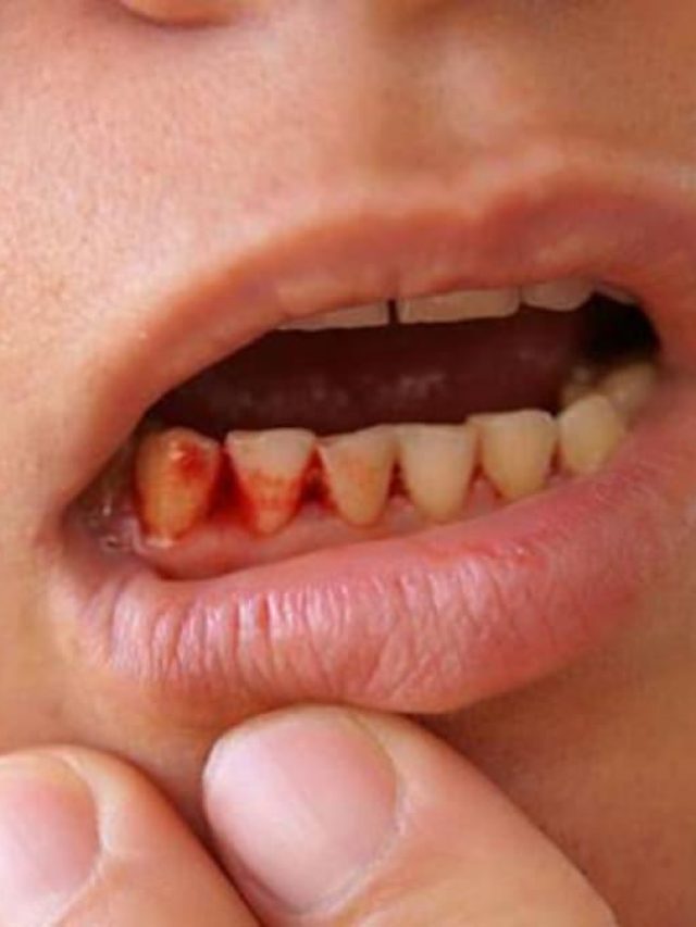 मुंह के छालों से परेशान हैं, तो रसोई की ये 4 चीजें लगाने से तुरंत मिलेगा आराम