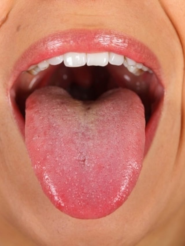 জিভ পুড়ে গেছে গরম কিছু খেতে গিয়ে? আরাম পেতে করুন ৫ কাজ