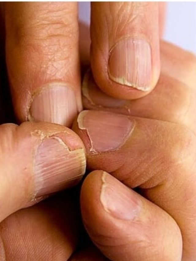 नाखून के रंग में छिपी है गंभीर बीमारी, पहचान तुरंत करें डॉक्टर का रुख