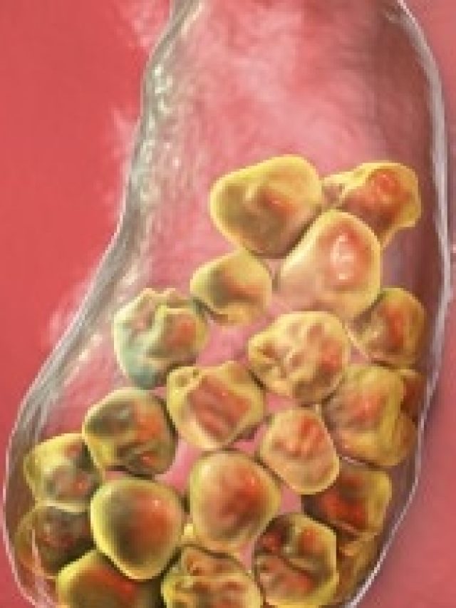 পেটে পাথর তৈরি হয় এসব ভুলেই, সতর্ক না হলেই ভুগবেন