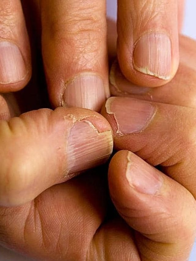 নখে থাকা দাগ দেখেই বুঝবেন কতদিন বাঁচবেন, জেনে নিন