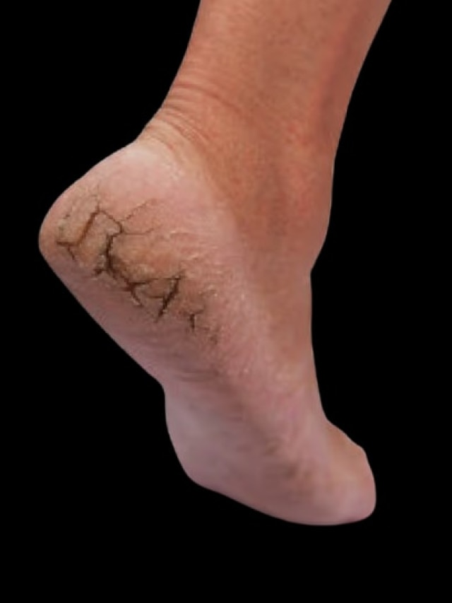 গোড়ালি ফেটে বিরাট ব্যথা? জানুন ঘরোয়া উপায়ে সারানোর উপায়