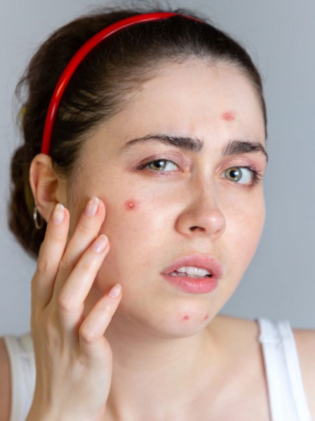 রাতারাতি কমবে লাল টসটসে ব্রণ, কাজে দেবে রান্নাঘরের মশলা