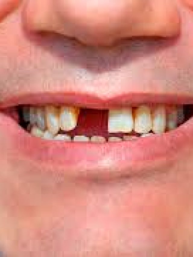 কাদের দাঁত তাড়াতাড়ি পড়ে যায়? যা বললেন দাঁতের ডাক্তার