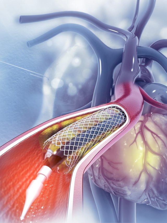 हार्ट ब्लॉकेज में लगने वाले स्टेंट के बारे सुना है, क्या आप जानते हैं वो दिखता कैसा है?