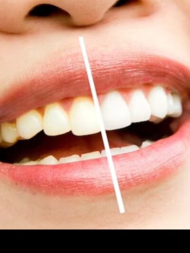 मोती जैसे सफेद हो जाएंगे दांत...इस एक चीज से जड़ से खत्म हो सकता है बरसों पुराना पीलापन