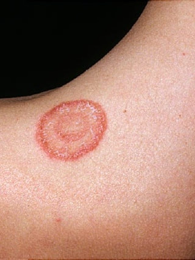 ঘাড়ের খাঁজে লাল গোল দাদ, চুলকানি কমবে ৪ ঘরোয়া টোটকায়