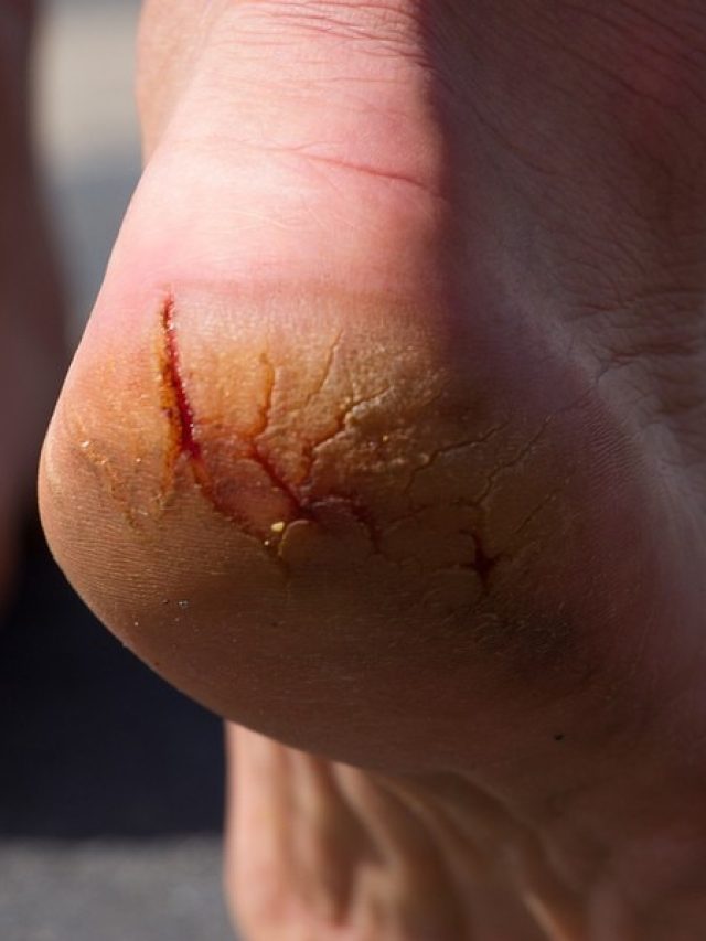 ফাটা গোড়ালির খাঁজে ঢুকে ময়লা, সস্তার তেলে পায়ের পাতা হবে নরম