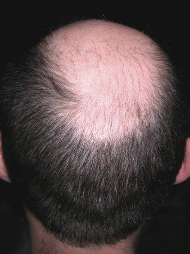 মাথার মাঝখানে চুল উঠে টাক? ন্যাড়া হওয়ার আগে এই সবজি ঘষে ফেলুন