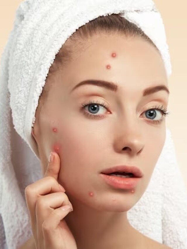 Pimples को कहें गुड बाय...इन सिंपल ट्रिक्स को अपना लें