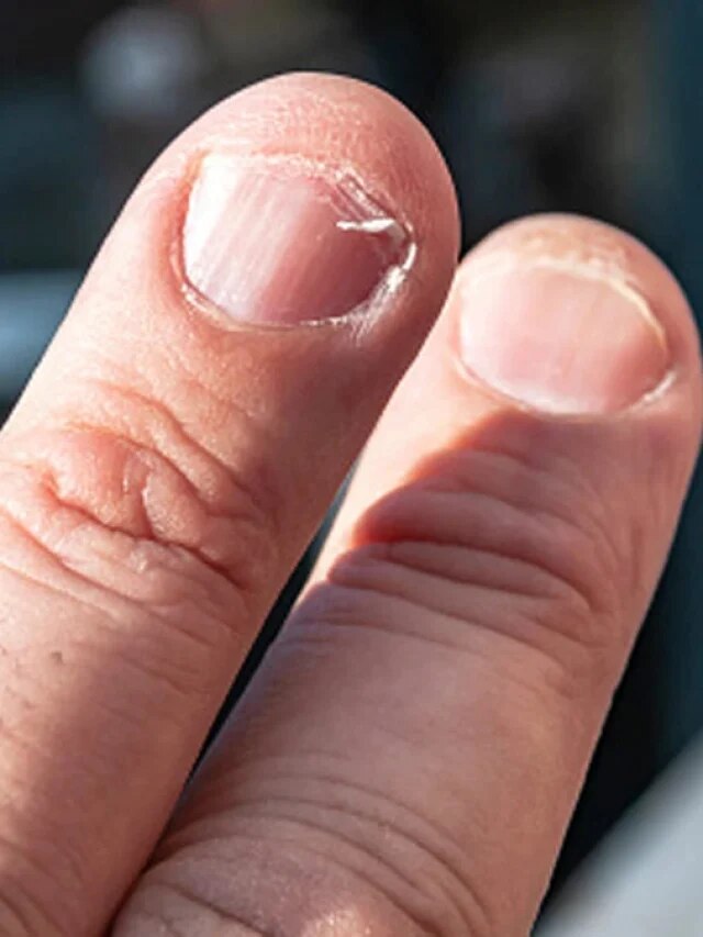 नाखून बताएंगे सेहत का हाल, जानें आप किन बीमारियों के हो सकते हैं शिकार
