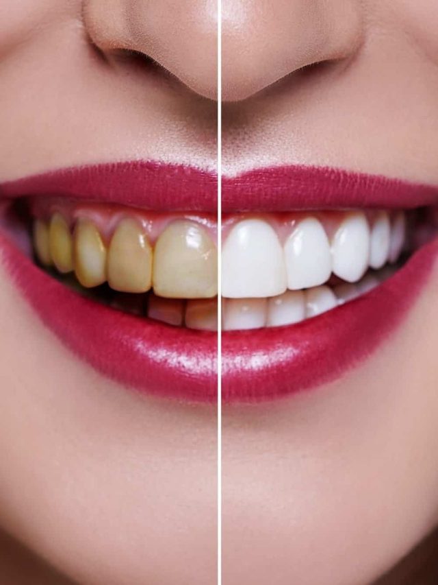 বারবার দাঁত মেজেও উঠছে না হলুদ দাগ? রইল ৩ ঘরোয়া টোটকা