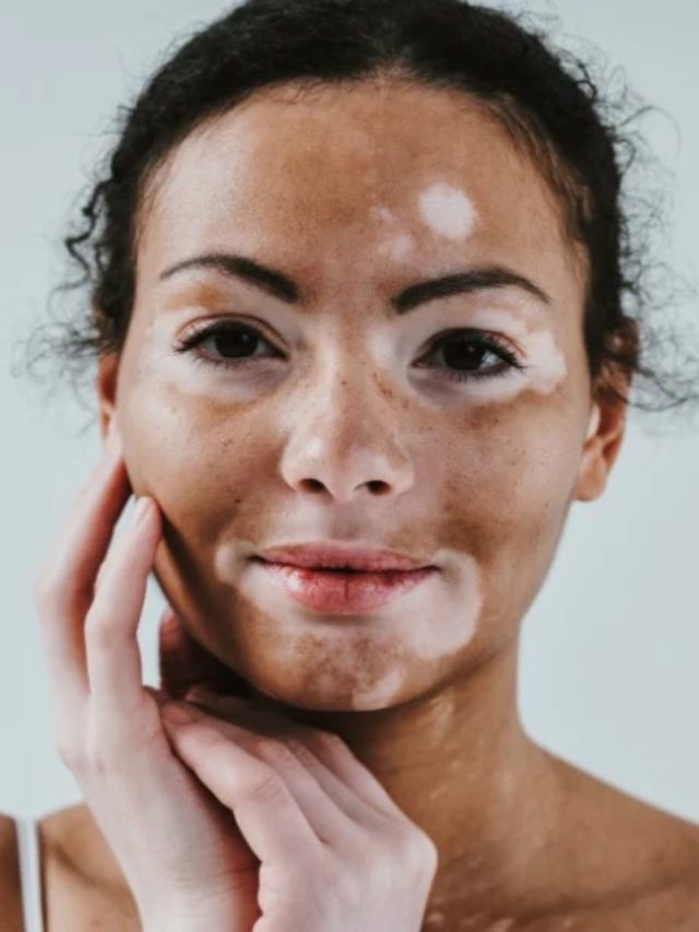 মুখের সৌন্দর্য কাড়ছে ছোপ ছোপ সাদা দাগ? এই জিনিসগুলি খাবেন না