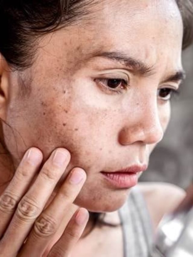 রোদে পুড়ে ঝামা মুখে খেলবে জেল্লা, সানবার্ন ১৫ মিনিটে দূর করুন এভাবে