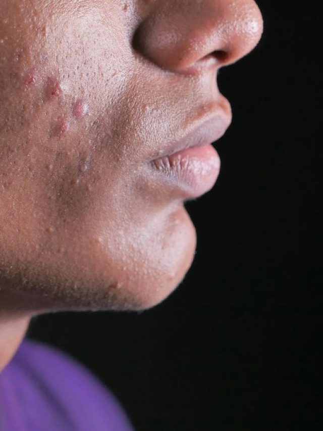 चेहरे पर निकला पिंपल तो छोड़ दी नौकरी! शख्स ने कहा- हेल्थ से कोई समझौता नहीं