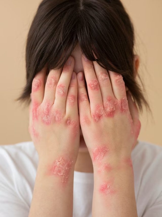 গরম পড়তেই ত্বকে ফুসকুড়ি? হিট র‍্যাশ এড়াতে এই কাজ গুলি করুন