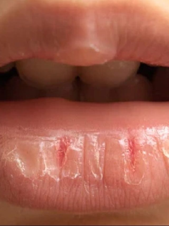 গরমেও ঠোঁট ফেটে চৌচির? ঘরোয়া উপায়েই হবে মোলায়েম