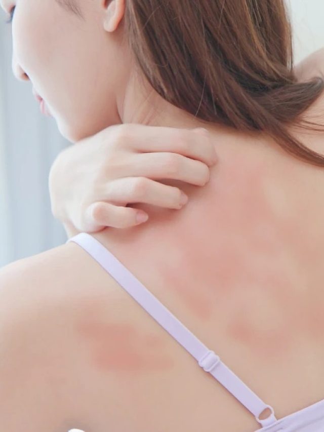 গা ভর্তি ঘামাচি দূর হবে রাতারাতি, কায়দাটা শিখে রাখুন