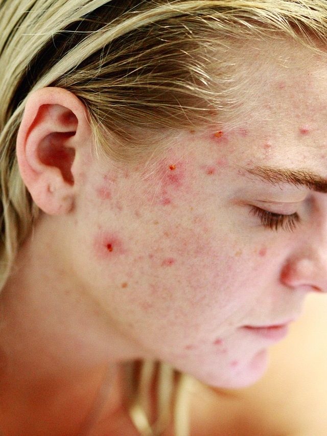 पिंपल-एक्ने से भर गया है पूरा चेहरा, इस सफेद चीज से तुरंत मिलेगा आराम