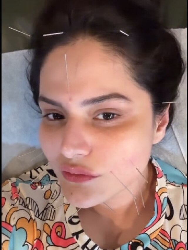 चेहरे पर चुभोई खूब सारी सुई, एक्ट्रेस पर सुंदर दिखने की सनक! कौन-सा लिया ट्रीटमेंट?