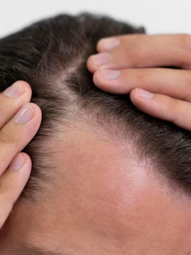 गंजे सिर पर फिर से उगाना चाहते हैं बाल? काम आ सकते हैं ये आसान टिप्स
