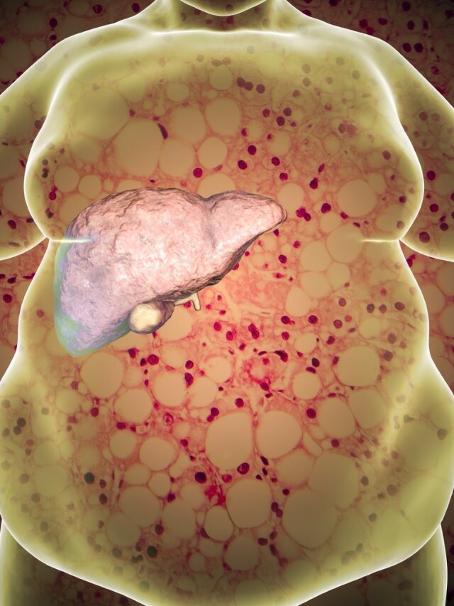 लिवर के लिए खतरनाक होते हैं ये 4 फूड्स, रोज खाने से सड़ सकता है Liver