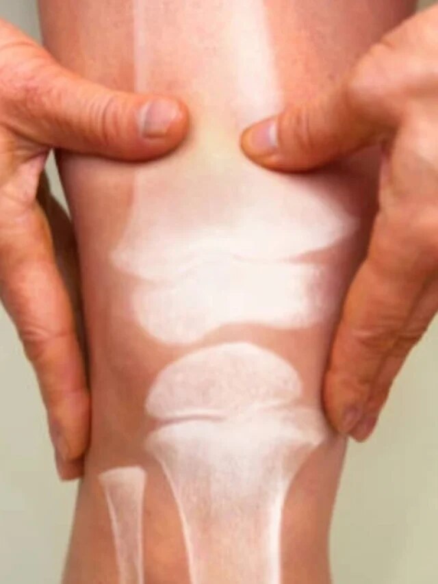 बढ़ा हुआ यूरिक एसिड कम करता है ये ड्राई फ्रूट, किडनी को भी रखेगा हेल्दी