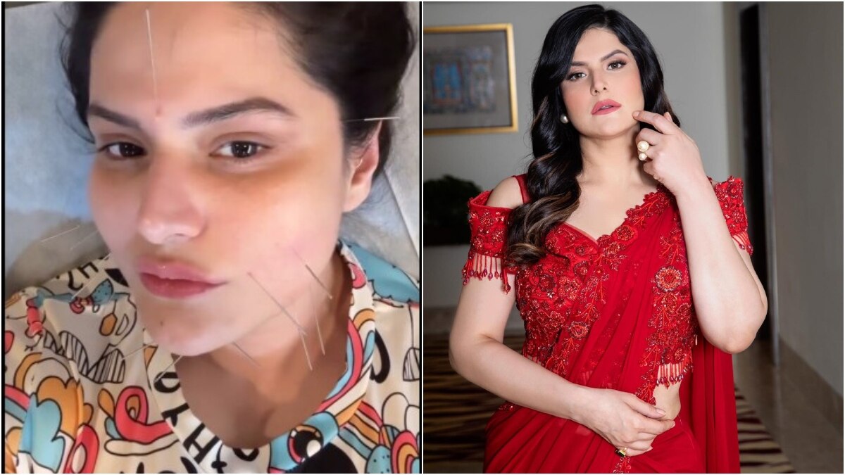 चेहरे पर चुभोई खूब सारी सुई, एक्ट्रेस पर सुंदर दिखने की सनक! कौन-सा लिया ट्रीटमेंट?