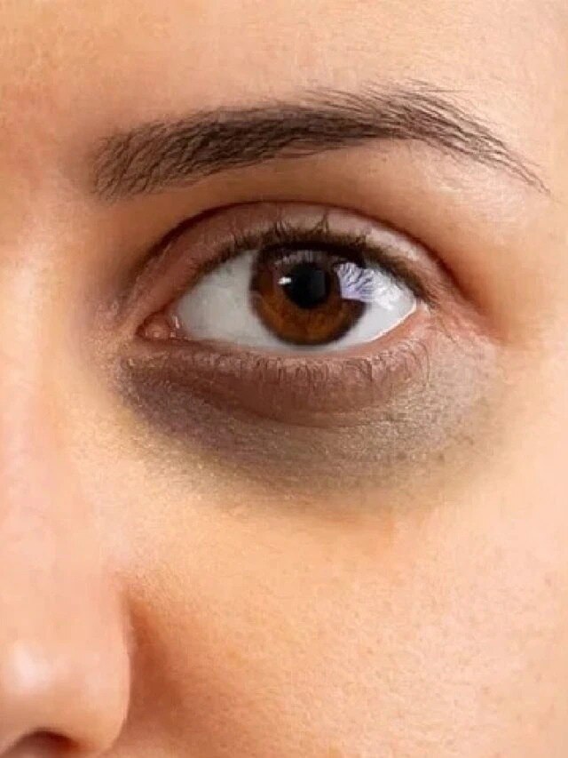 ডার্ক সার্কেল থেকে মিলবে মুক্তি, মাত্র ৫ টাকাতেই হবে কাজ